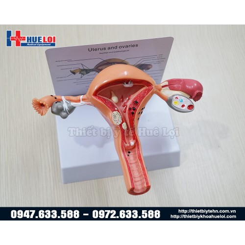 Mô hình tử cung và phần phụ bệnh lý